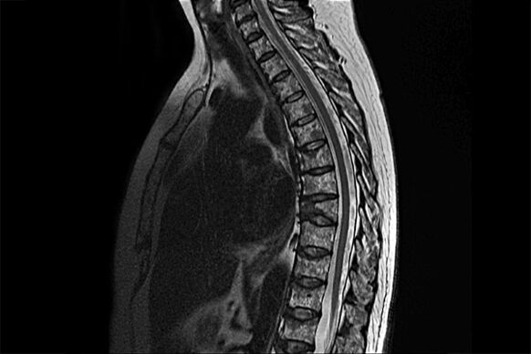 Manifestações da osteocondrose torácica na imagem da ressonância magnética