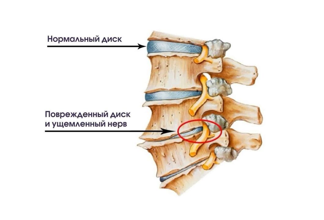 Sintomas de osteocondrose cervical