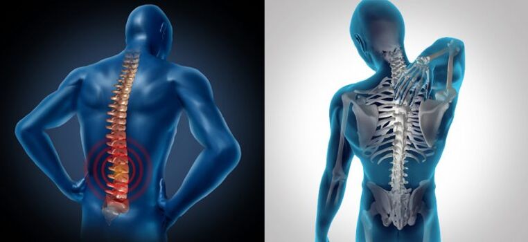 Inflamação na osteocondrose espinhal