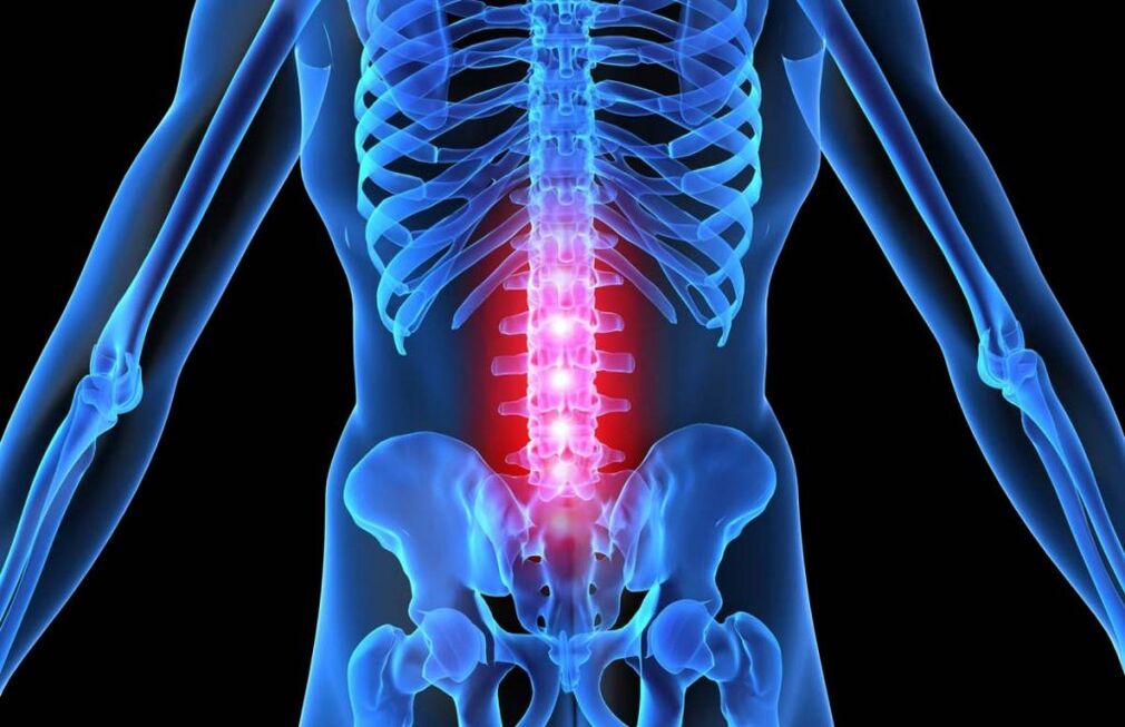 Osteocondrose da coluna lombar