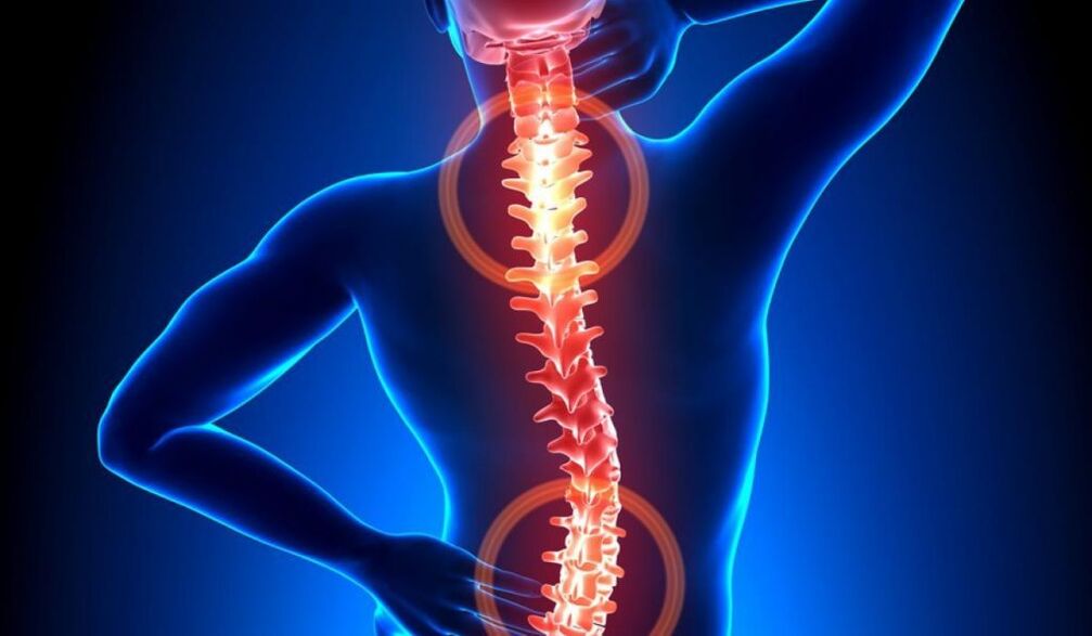 osteocondrose espinhal
