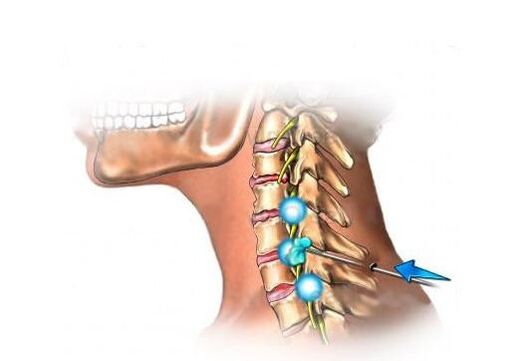 tratamento de osteocondrose cervical